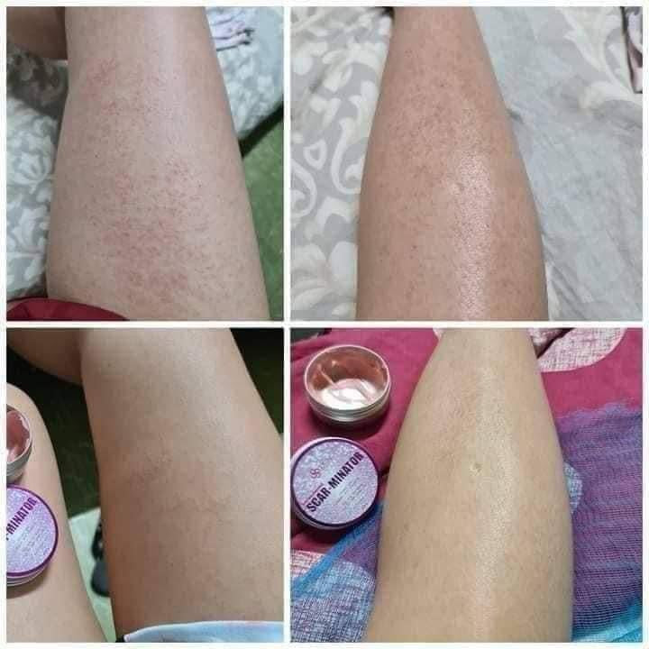 SCARMINATOR CREAM